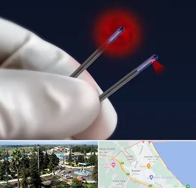 جراحی سینه با لیزر در رودسر