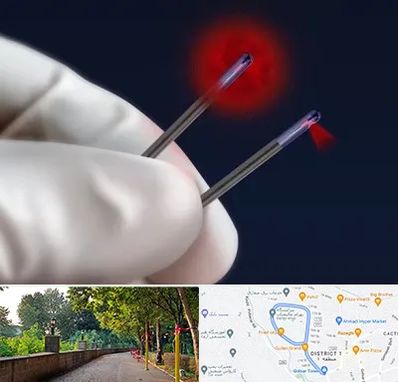 جراحی سینه با لیزر در فلکه گاز رشت