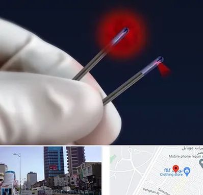 جراحی سینه با لیزر در چهارراه طالقانی کرج