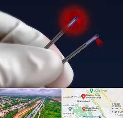 جراحی سینه با لیزر در قصرالدشت شیراز