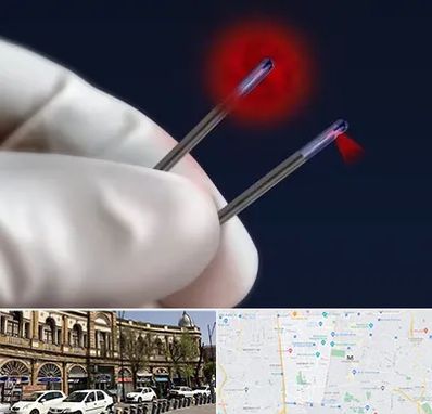 جراحی سینه با لیزر در منطقه 11 تهران 