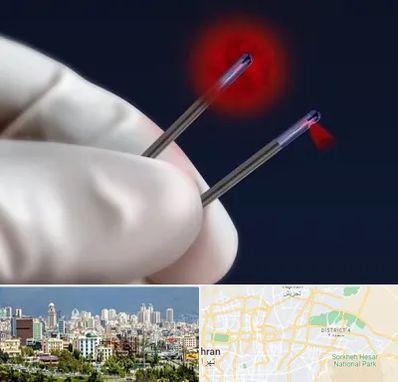 جراحی سینه با لیزر در شرق تهران 