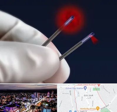 جراحی سینه با لیزر در گلسار رشت 