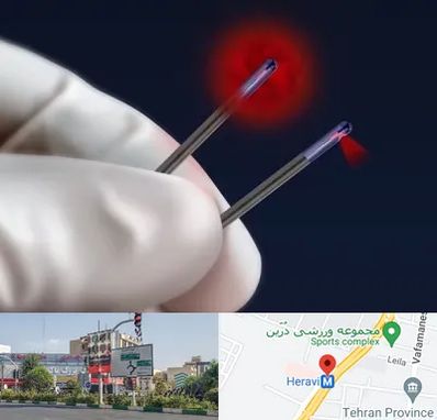 جراحی سینه با لیزر در هروی 