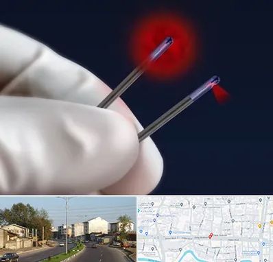 جراحی سینه با لیزر در ضیابری رشت