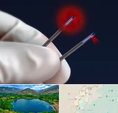 جراحی سینه با لیزر در رودبار