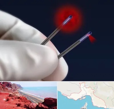 جراحی سینه با لیزر در هرمزگان
