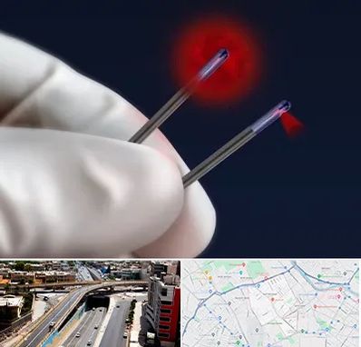 جراحی سینه با لیزر در ستارخان شیراز