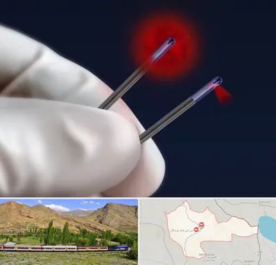 جراحی سینه با لیزر در خاش