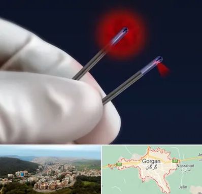 جراحی سینه با لیزر در گرگان