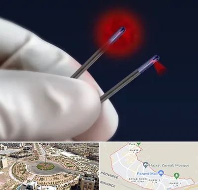 جراحی سینه با لیزر در پرند