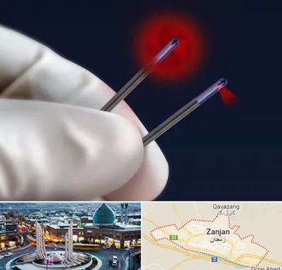 جراحی سینه با لیزر در زنجان