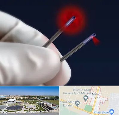 جراحی سینه با لیزر در ملارد