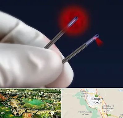 جراحی سینه با لیزر در بروجرد