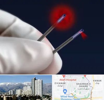 جراحی سینه با لیزر در شهرک غرب 