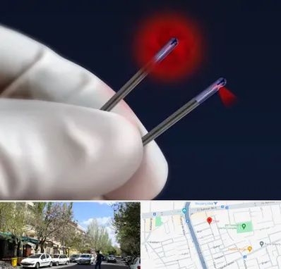 جراحی سینه با لیزر در کوی فیروز تبریز