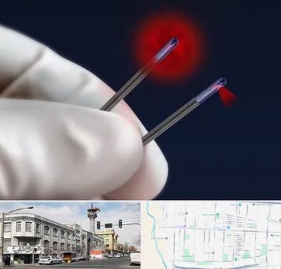 جراحی سینه با لیزر در 17شهریور