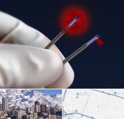 جراحی سینه با لیزر در ازگل