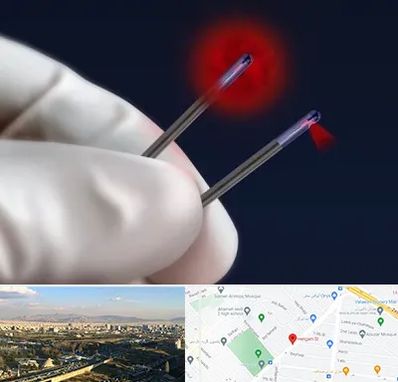 جراحی سینه با لیزر در هنگام 