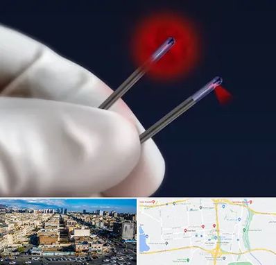 جراحی سینه با لیزر در شهرک راه آهن