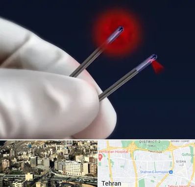 جراحی سینه با لیزر در مرزداران 