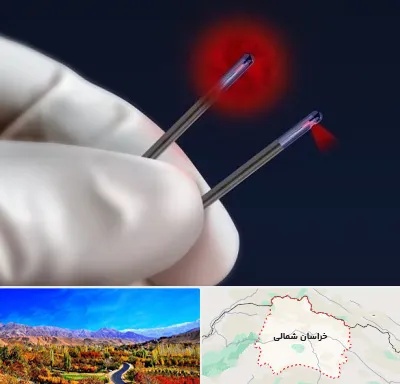 جراحی سینه با لیزر در خراسان شمالی