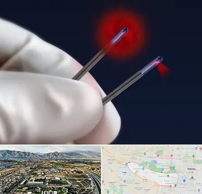 جراحی سینه با لیزر در منطقه 21 تهران 