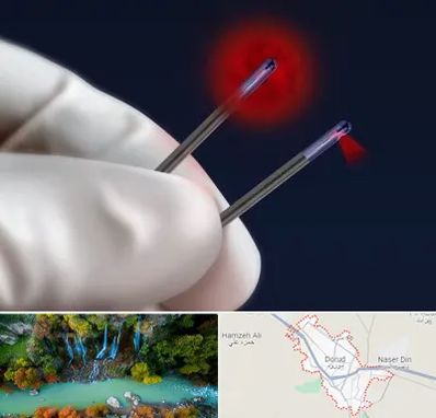 جراحی سینه با لیزر در دورود