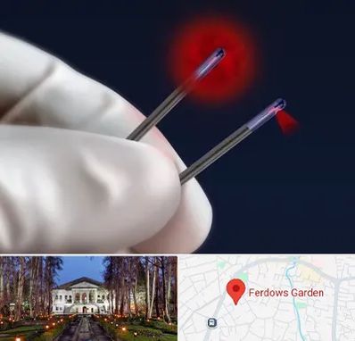 جراحی سینه با لیزر در باغ فردوس