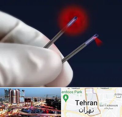 جراحی سینه با لیزر در صادقیه 