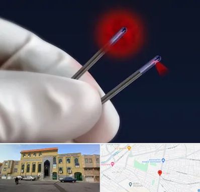 جراحی سینه با لیزر در زنبیل آباد قم