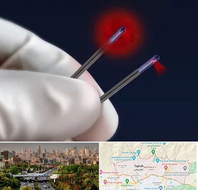 جراحی سینه با لیزر در منطقه 1 تهران 