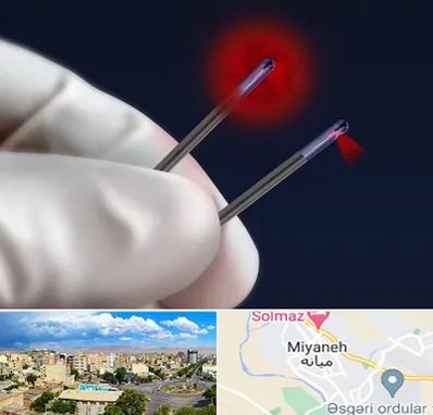 جراحی سینه با لیزر در میانه