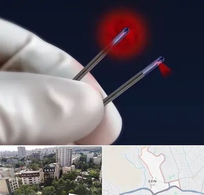 جراحی سینه با لیزر در اوین