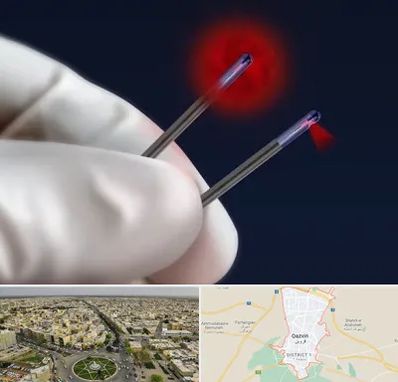 جراحی سینه با لیزر در قزوین