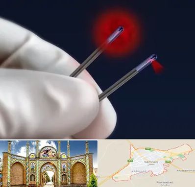 جراحی سینه با لیزر در سمنان
