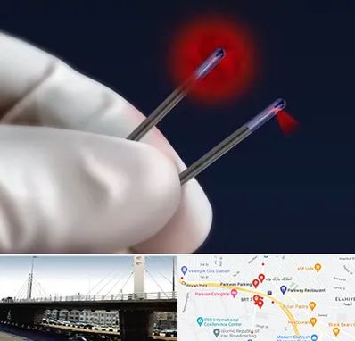 جراحی سینه با لیزر در پارک وی 