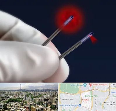 جراحی سینه با لیزر در گیشا 