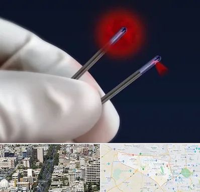 جراحی سینه با لیزر در منطقه 18 تهران 