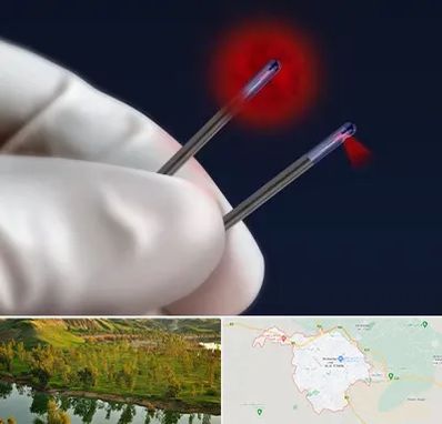 جراحی سینه با لیزر در بهبهان