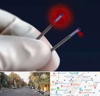 جراحی سینه با لیزر در شریعتی 