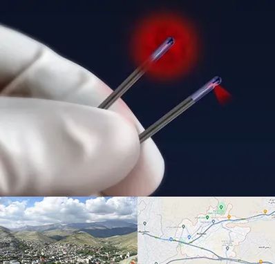 جراحی سینه با لیزر در رودهن