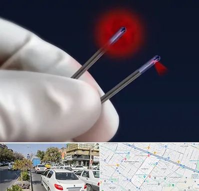 جراحی سینه با لیزر در مفتح مشهد