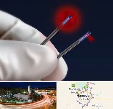 جراحی سینه با لیزر در همدان