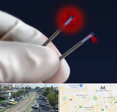 جراحی سینه با لیزر در جنوب تهران 