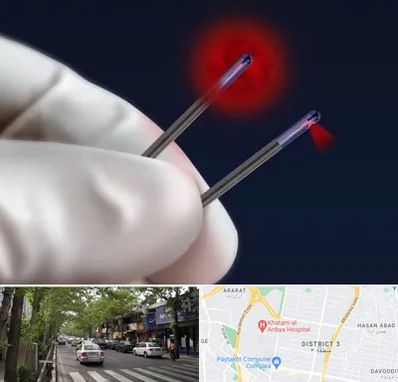 جراحی سینه با لیزر در ظفر 