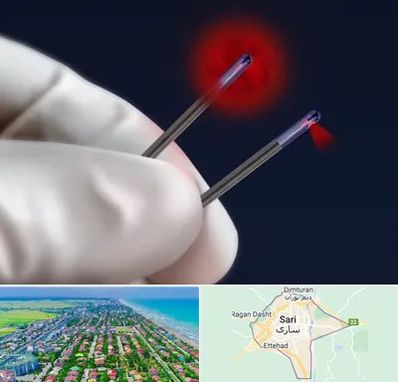 جراحی سینه با لیزر در ساری