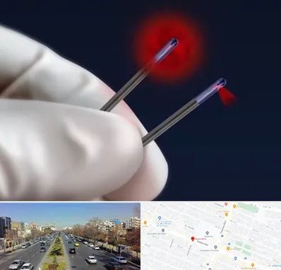 جراحی سینه با لیزر در بلوار معلم مشهد