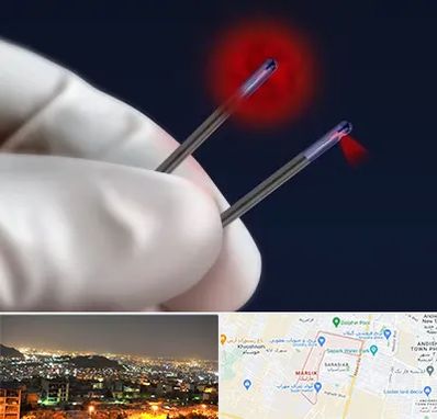 جراحی سینه با لیزر در مارلیک کرج