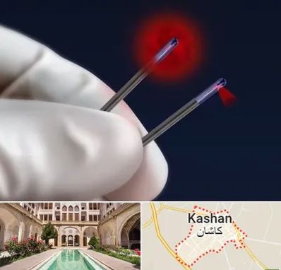 جراحی سینه با لیزر در کاشان